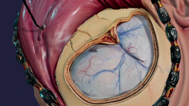 Pterional Craniotomy Operative View